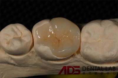 Cina Porcellana senza cuciture Emax Finiture Rimpiazzo dentale aspetto autentico in vendita