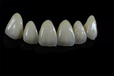 China Natural Looking Aesthetic Ceramic Emax Veneer Dental Material Customized for sale