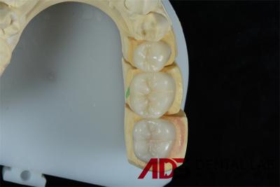 China Biocompatible Ceramic 3D Emax Veneers For Tooth Restorations for sale