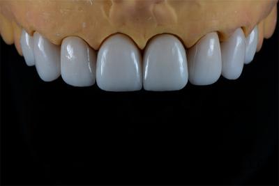 China Natural Porcelain E-Max Crown Full Veneer In Demistry Restorations for sale