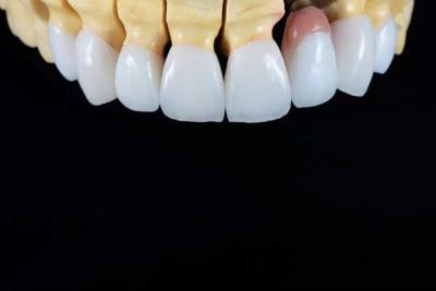 China OEM Veneers Dental E-Max Coroas Resistência à mancha Minimamente invasivo à venda