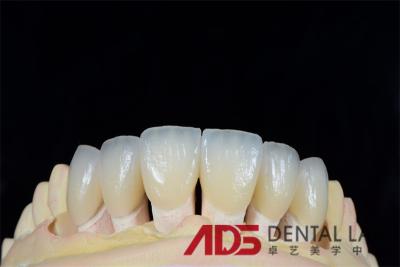 China Customized Dental Veneers Offer Perfect Color Match and Comfortable Fit en venta