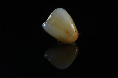 Cina Corone di zirconia di alta qualità con macchie di aspetto naturale - Cina Produttore dentale in vendita