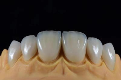 China Custom Emax Dental Veneer from Leading China Dental Lab for sale