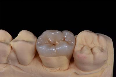 Cina Corona di zirconia minimamente invasiva per un design naturale del sorriso in vendita