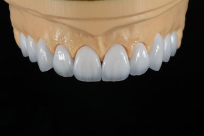 Cina Finitura dentale Emax personalizzata da un laboratorio dentistico leader in Cina in vendita