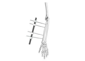 China Ulna And Radius External Fixator Fracture Reduction Stable Fixation Adjustable for sale