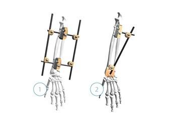 China Durable Orthopedic External Fixation Device , Ulna And Radius External Fixator for sale