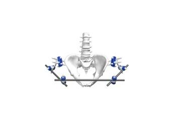 China Fijación externa ortopédica Fixator externo Fixator externo pélvico en venta