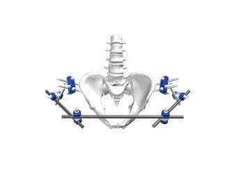 Chine Fixation externe de la dissection IV Φ8-Pelvic de système de fixation d'accolade orthopédique à vendre