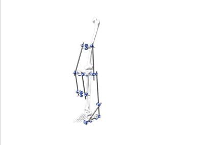 Chine Hybride de configuration Fixator externe pour des fractures proximales et distales de tibia à vendre