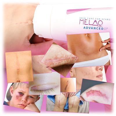 China MELAO OEM/ODM Skin Revitalizer Wholesale Supplier Repair Treatment Skin Care Cream Ointment Scar Gel Remove Scar And Acne Marks for sale