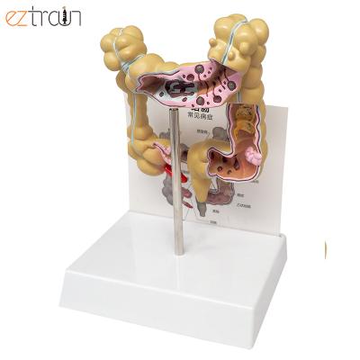 China Anatomical Model Lesion Medical Model Education Large Intestine Colon Pathological Model for sale