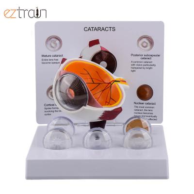 China PVC 5 Cataract States Show Oversized Human Education Eye Anatomy Cataract Eye Model for sale