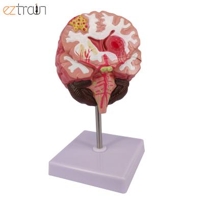 China 1 PC Human Brain Anatomy Model with Pathologies, Stroke, Subdural Hematoma, Migraine for sale