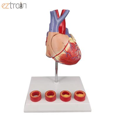 China 2 part detachable heart model, atherosclerosis model with 4 stages of coronay artery disease display for sale