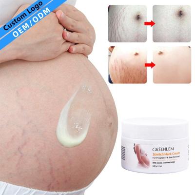 China Skin Revitalizer Private Label 100% Natural Vegan Postpartum Deep Scar Removal Anti Acne Stretch Mark Cream for sale