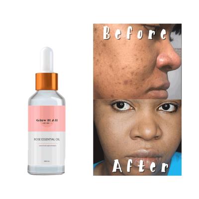 China Skin Revitalizer Factory Direct Supply Glow It All Brand Private Label Whitening Face Treatment Oil For Acne for sale