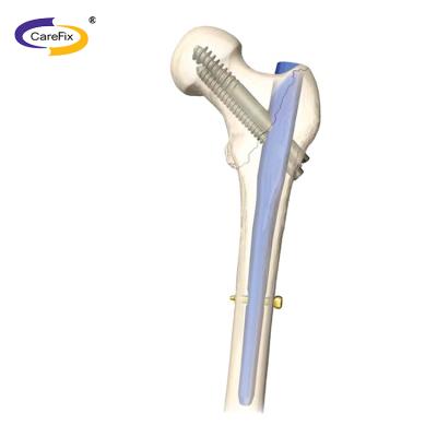 China Titanium Alloy Implant Orthopedic Femur Nail Proximal Orthopedics , Orthopedic Surgical Implants for sale