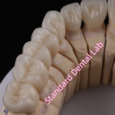 Cina Digital CAD CAM Dental Lab PFZ Corone Traslucide a strati Corona di zirconia in vendita