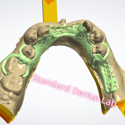 China Metallrahmen-Design Laserdruck Gusschrom-Teilprothese Ni Be Free zu verkaufen