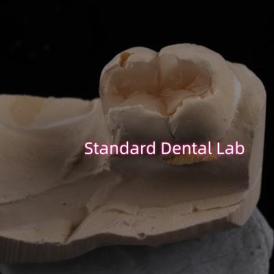 China Cast Porcelain Dental Inlay Onlay Overlay Zirconia Emax High Esthetics for sale