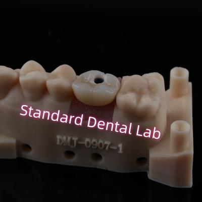 China Custom Abutment Implant Crown Full Contour Zirconia Screw Retained for sale