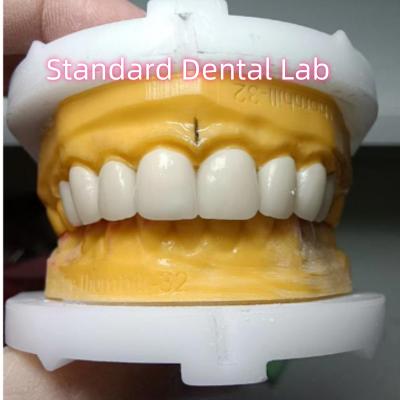 China Ivoclar Zirkonia Kronen Veneers Hohe Durchsichtigkeit Ästhetisch zu verkaufen