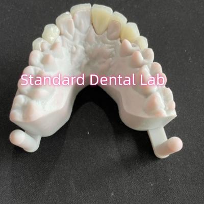 China Stars' Smile Dental Teeth Emax Zirconia Laminate Veneers 0.6mm for sale