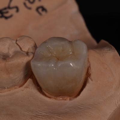 Cina Corona di zirconia trasparente a contorno completo per risultati esteticamente gradevoli in vendita