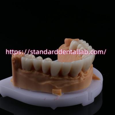 China FDA Alta Estética Dental Zirconia Ponte Com Coroa Dental de Zirconia de Porcelana Camadas China Dental Lab à venda