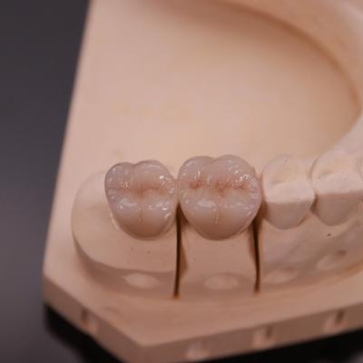 China Comfortable Zirconia Crown with Precise Esthetic Finish Express 3-4 Day Turnaround Time for sale