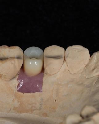 China Implant Screw Cement Retained The Perfect Solution for Long-Lasting Dental Implants for sale