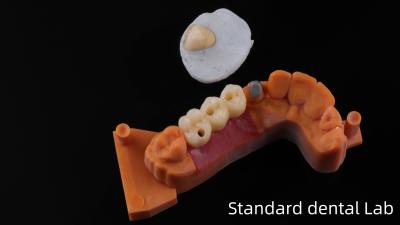 China Post Core Dental Lab from China / Metal Post Core with PFM Crown for sale