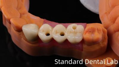 Cina Impianto dentale di zirconio professionale Corona di titanio CAD CAM Corona di zirconio Laboratorio dentale cinese in vendita