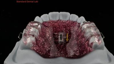 China Expansión y desestabilización de los dientes Expansión de ajuste en la boca Ortodoncista Expansión del paladar en venta