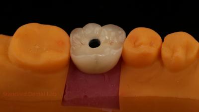 Cina Croce di impianto dentale in porcellana stratificata in zirconia di PFZ a vite da laboratorio dentale certificata ISO FDA CE con garanzia di 5 anni in vendita