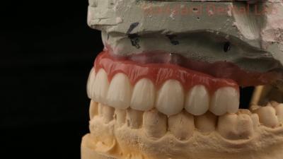 China Coronilla de implantes dentales con tornillo de titanio híbrido todo en 4 puente de implantes dentales de zirconia en venta