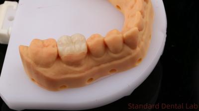 China Translúcido Zirconia Dental Inlay Onlay Coroa Para Restaurar a Forma Natural da Cavidade / Laboratório Dental Padrão à venda