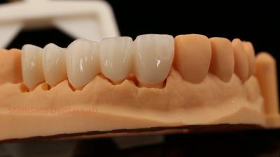 China High Aesthetic Anterior Teeth Full Contour Zirconia Crown with Customized Vita Shade Dental Lab for sale