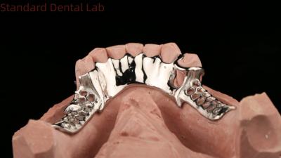 China Cobalt Chrome Cast Metal Framework Partial Dentures With Lower Apron Design SDL Dental Lab for sale