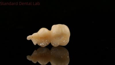 China Dental Digital Corona completa de zirconia con modelo de impresión en 3D SDL Dental Lab Zirconia Onlay en venta