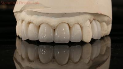 China China Dental Lab Zirconia Full Contour Crown High Aesthetic Natural Dental Bridge 5 Year Guarantee for sale