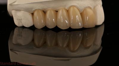 China Noritake Porcelian Full Contour Zirconia Crown High Aesthetic Natural Customized Zirconia Dental Bridge for sale