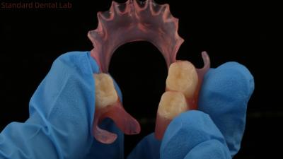 Chine Dentiste TCS Valplast Dentures partielles flexibles Nesbit Valplast Finition Chine Laboratoire dentaire Valplast Fermeture à vendre