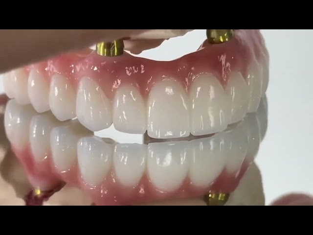 Dental All On X Implant PFM Crown Titanium Fixed Hybrid Denture