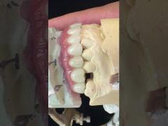 Titanium Implant Supported Dentures Precise Ivoclar Denture Over Implants