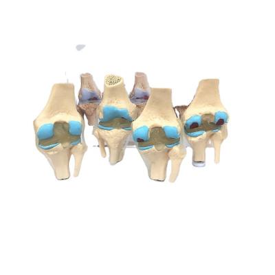 China High Quality Osteoarthritis Medical School /biology Class /drug Promotion Human Anatomy Model Teaching Stages for sale