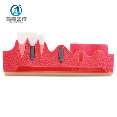 China Hot Selling Realistic Simulation Implant Dental Models for Patient Teaching for sale