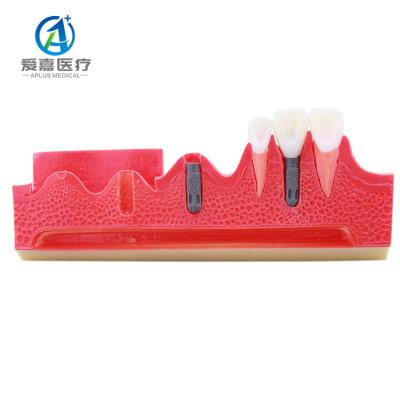 China Realistic Simulation High Quality Drills Medical Science Restoration With Implant Teeth Model for sale